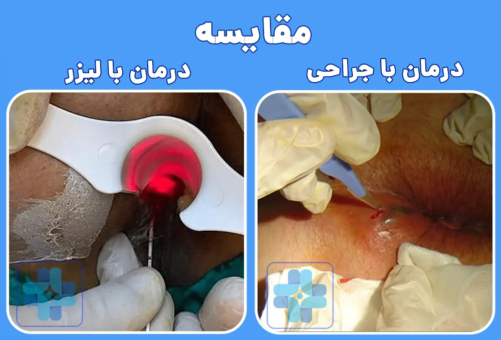 مقایسه درمان آبسه با جراحی و لیزر