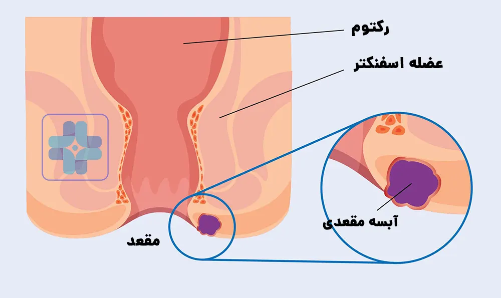 آبسه مقعدی چیست؟