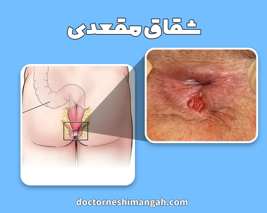 شقاق مقعدی چیست؟