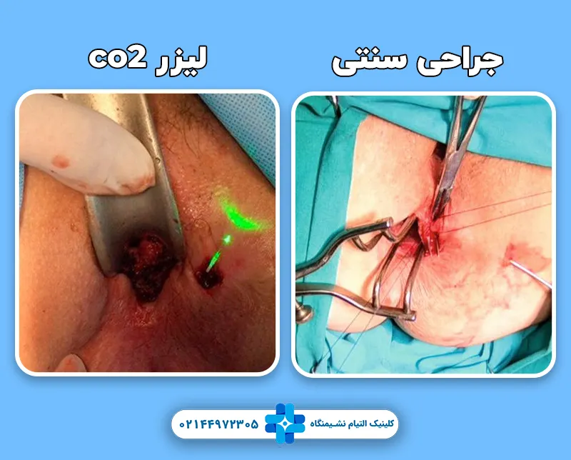 مقایسه لیزر co2 با جراحی سنتی در درمان فیستول
