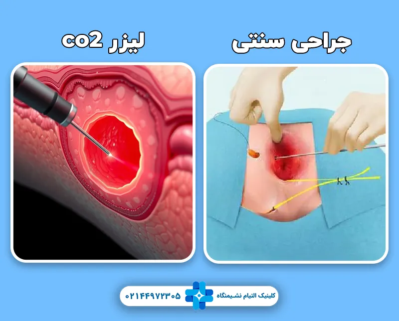مقایسه لیزر co2 با جراحی سنتی در درمان فیستول