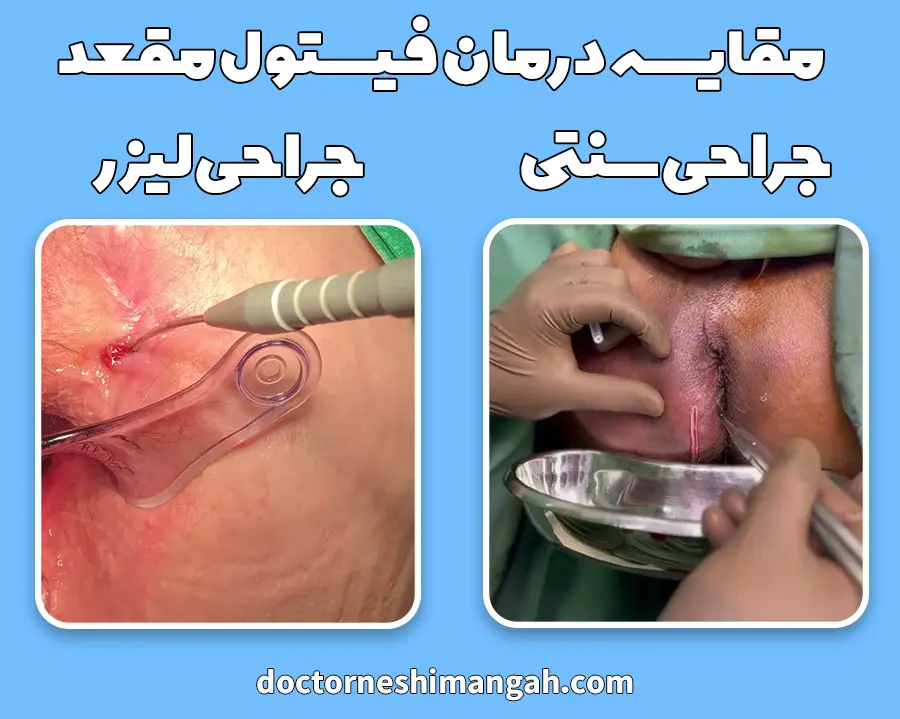 مقایسه جراحی سنتی فیستول مقعدی با لیزر