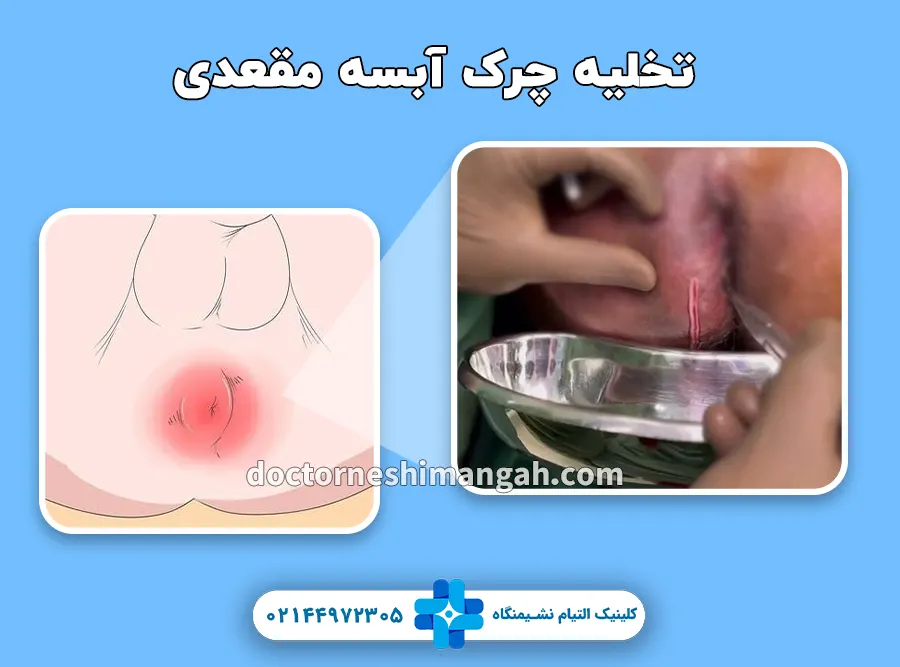 تخلیه چرک آبسه مقعدی