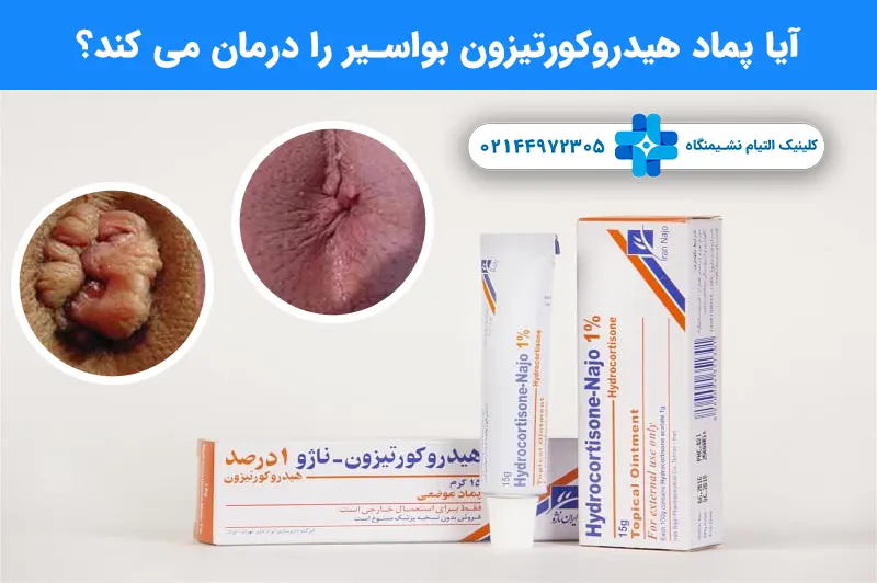 درمان بواسیر با پماد هیدروکورتیزون