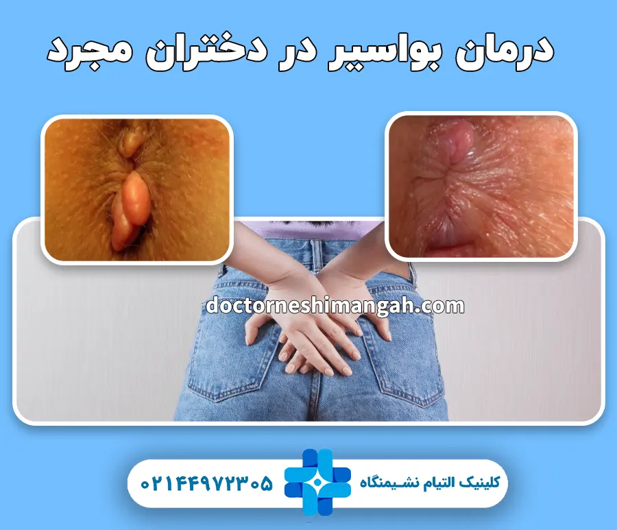 درمان بواسیر در دختران مجرد
