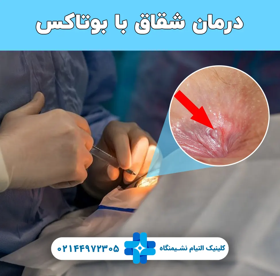 بوتاکس شقاق