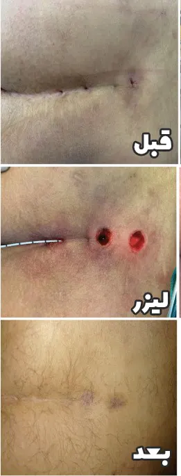 قبل و بعد کیست مویی با لیزر