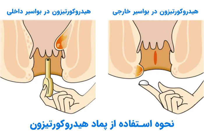 نحوه استفاده از پماد هیدروکورتیزون برای درمان بواسیر