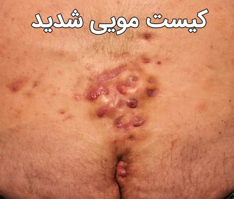 کیست مویی شدید
