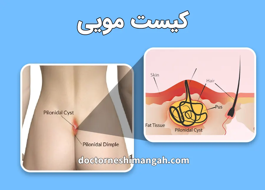 کیست مویی چیست؟