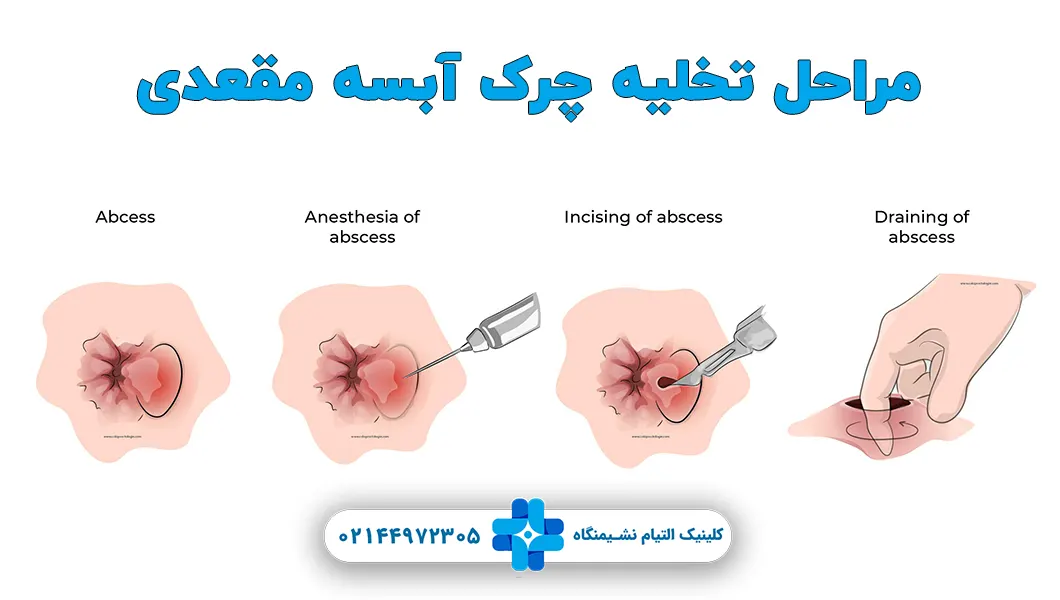 جوش مقعدی در بارداری