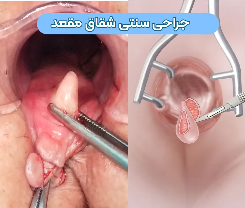 جراحی سنتی شقاق