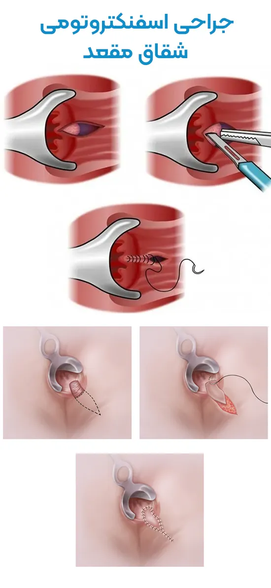 جراحی اسفنکتروتومی شقاق