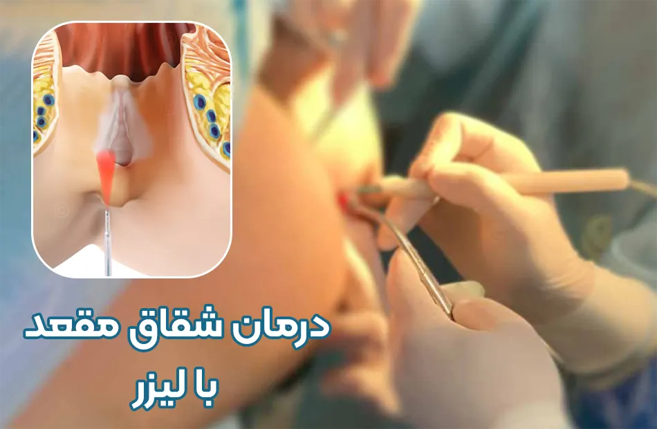 درمان شقاق با لیزر