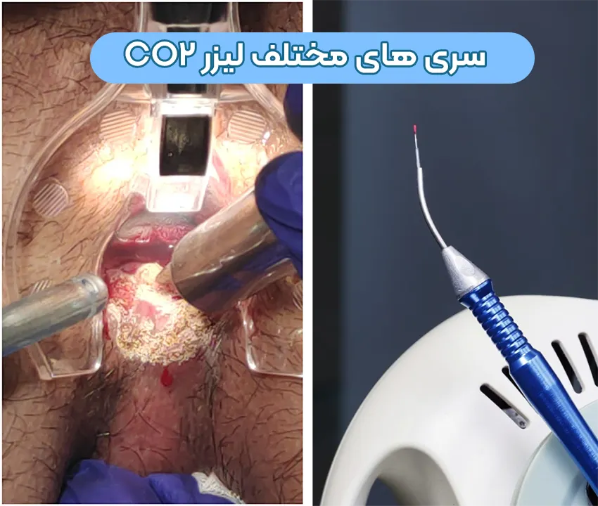 لیزر شقاق مقعد