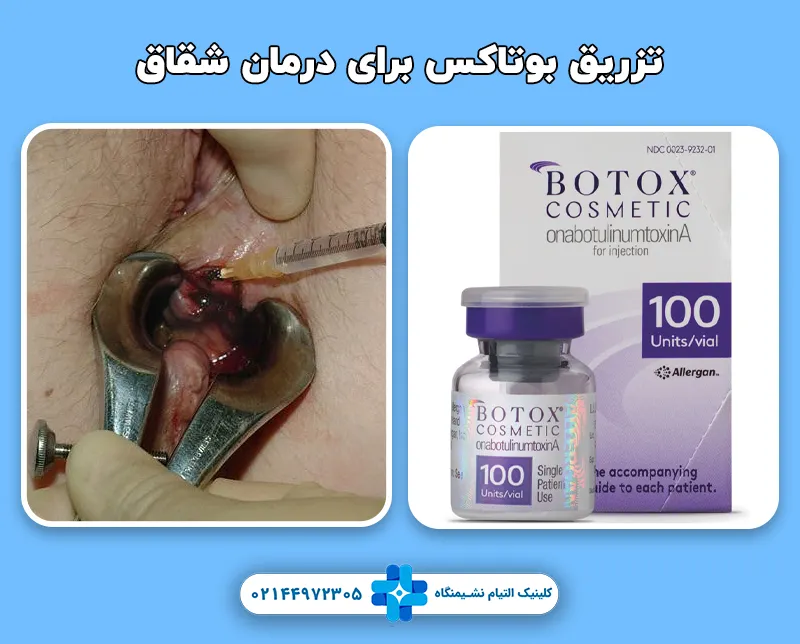 درمان شقاق با بوتاکس