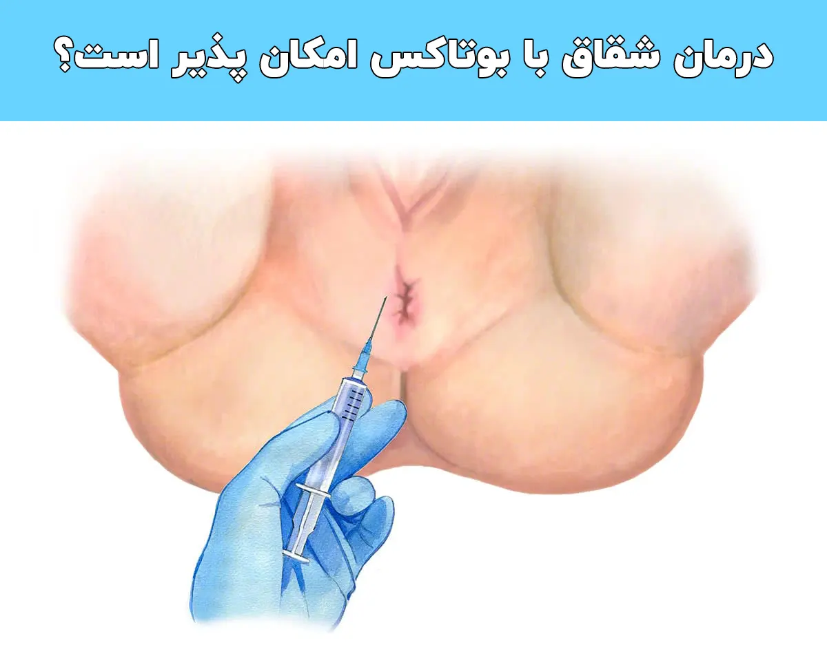 درمان شقاق با تزریق بوتاکس