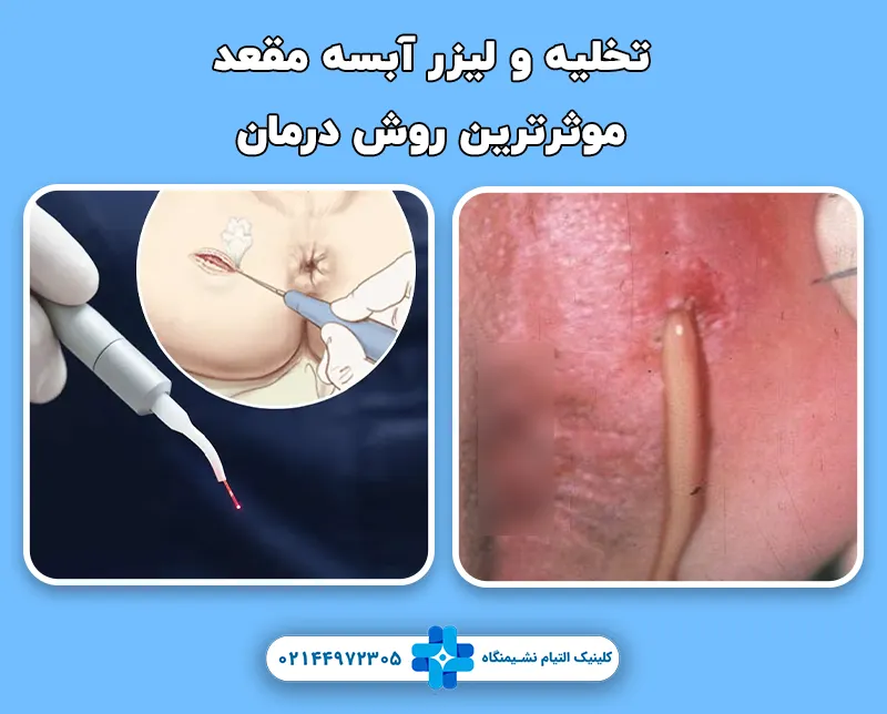 تخلیه و لیزر آبسه مقعد