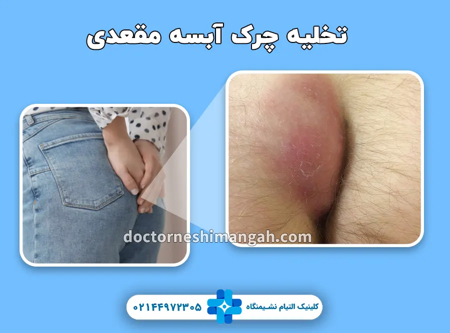 تخلیه چرک آبسه مقعدی