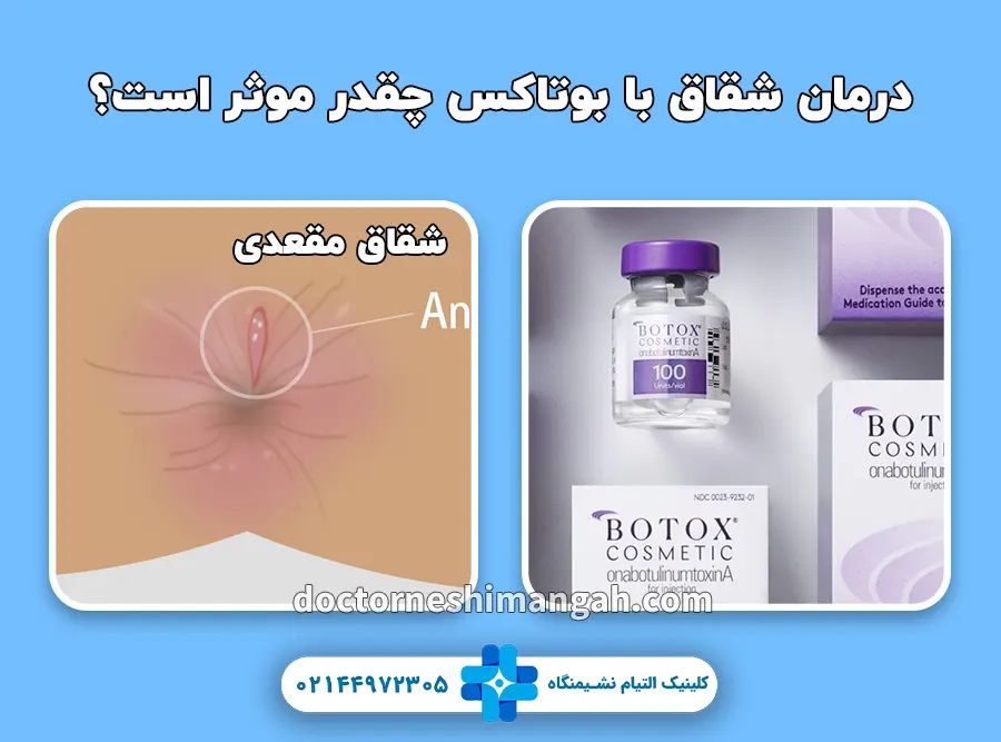 درمان شقاق با بوتاکس چقدر موثر است؟