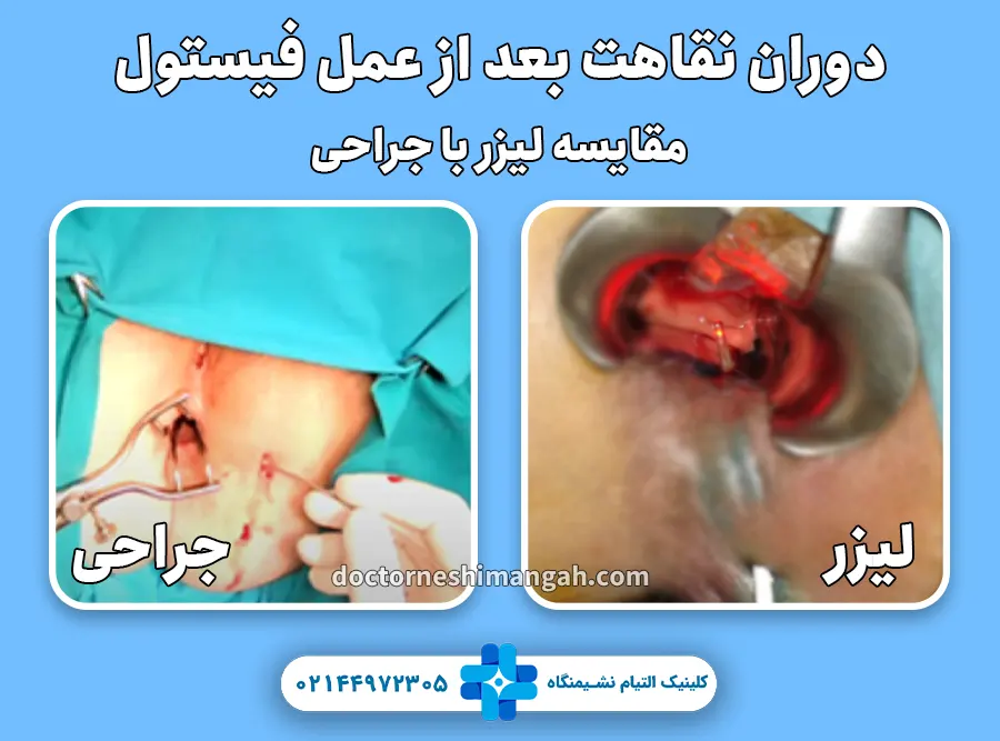 دوران نقاهت بعد از عمل فیستول