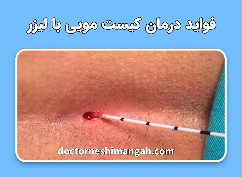 فواید درمان کیست مویی با لیزر