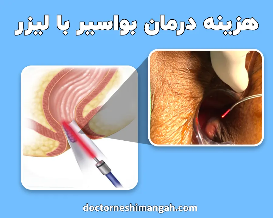 هزینه جراحی بواسیر با لیزر