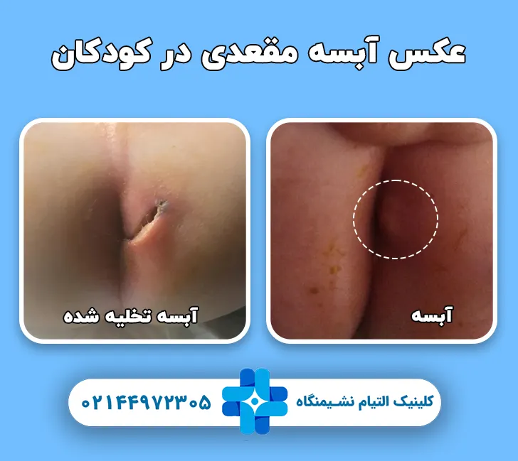 آبسه مقعدی در کودکان