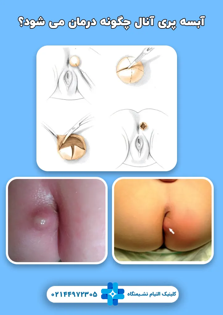 درمان آبسه پری آنال