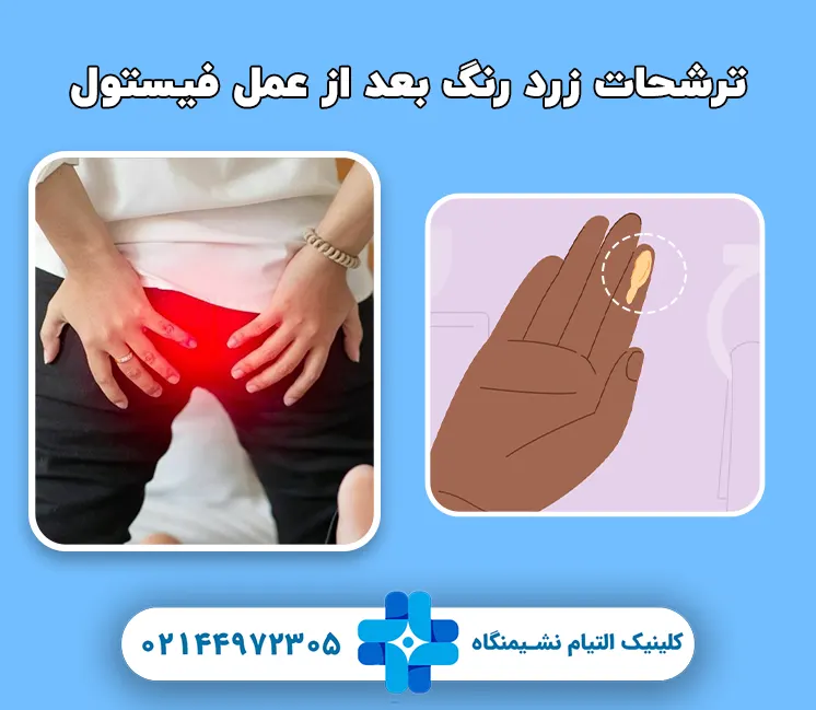 ترشحات زرد رنگ بعد از عمل فیستول