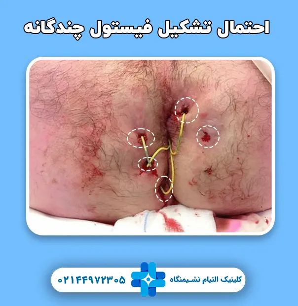 فیستول چندگانه