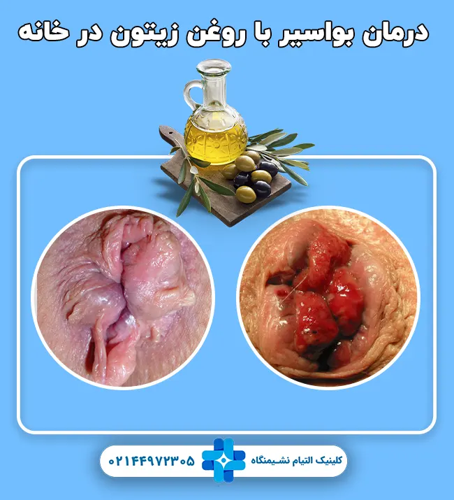 درمان بواسیر با روغن زیتون