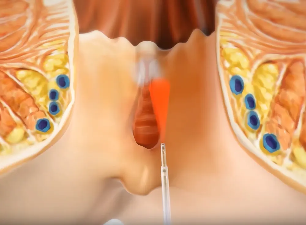 درمان شقاق با لیزر