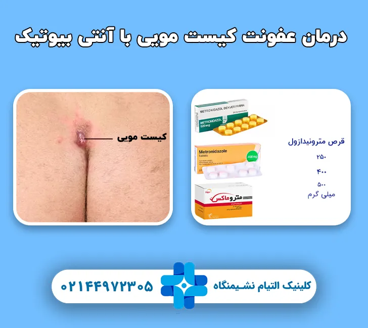 درمان عفونت کیست مویی با آنتی بیوتیک