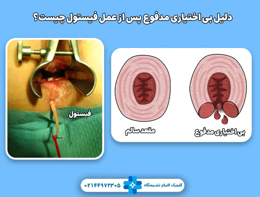 دلیل بی اختیاری مدفوع پس از عمل فیستول چیست