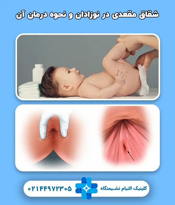 شقاق مقعدی در نوزادان و نحوه درمان آن