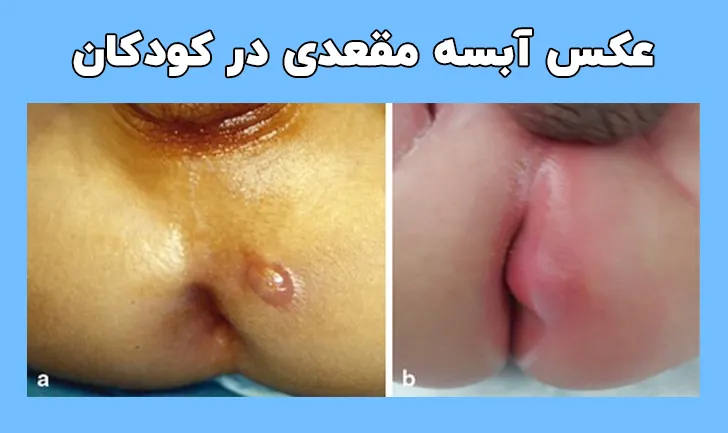 عکس آبسه مقعدی در کودکان