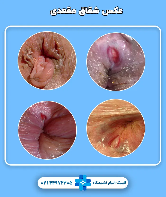 عکس شقاق مقعدی