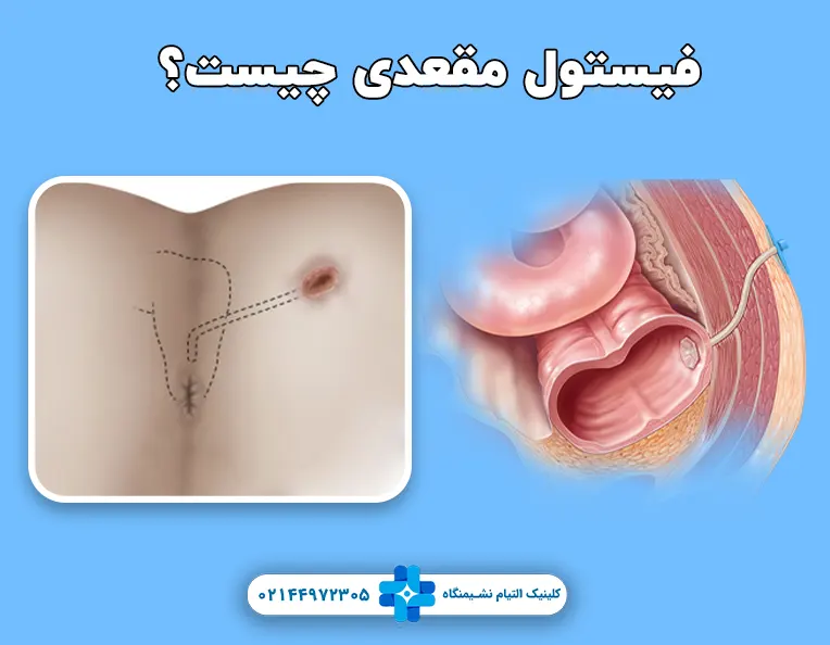 فیستول مقعدی