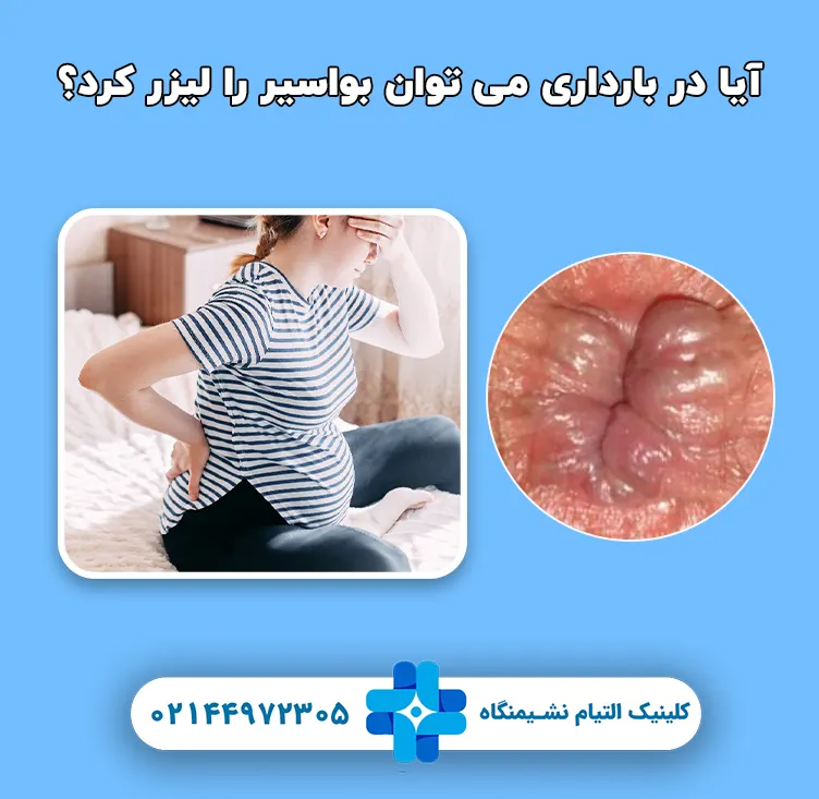 آیا در بارداری می توان بواسیر را لیزر کرد؟