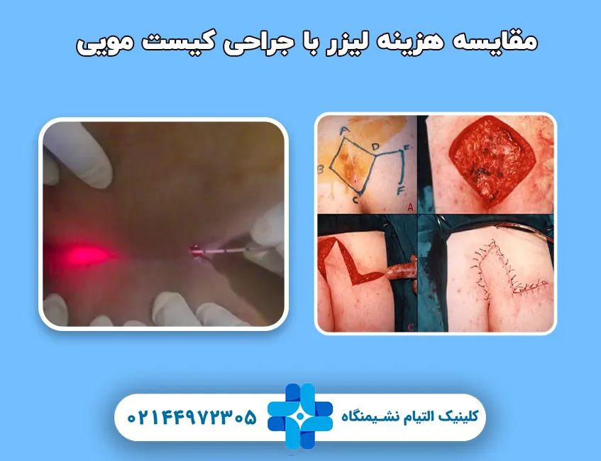 مقایسه هزینه لیزر و جراحی کیست مویی