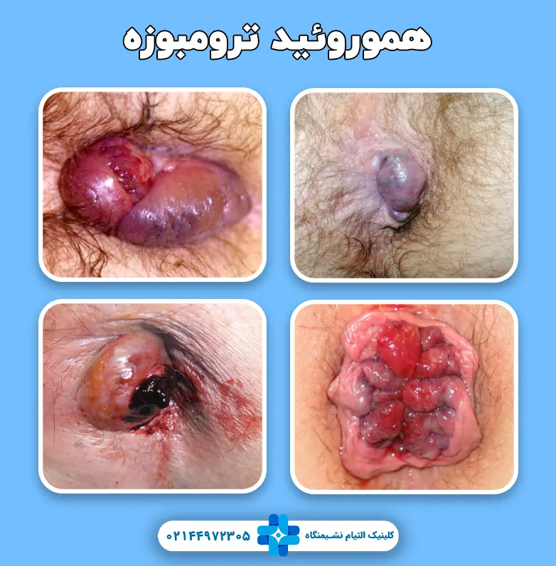 هموروئید ترومبوزه