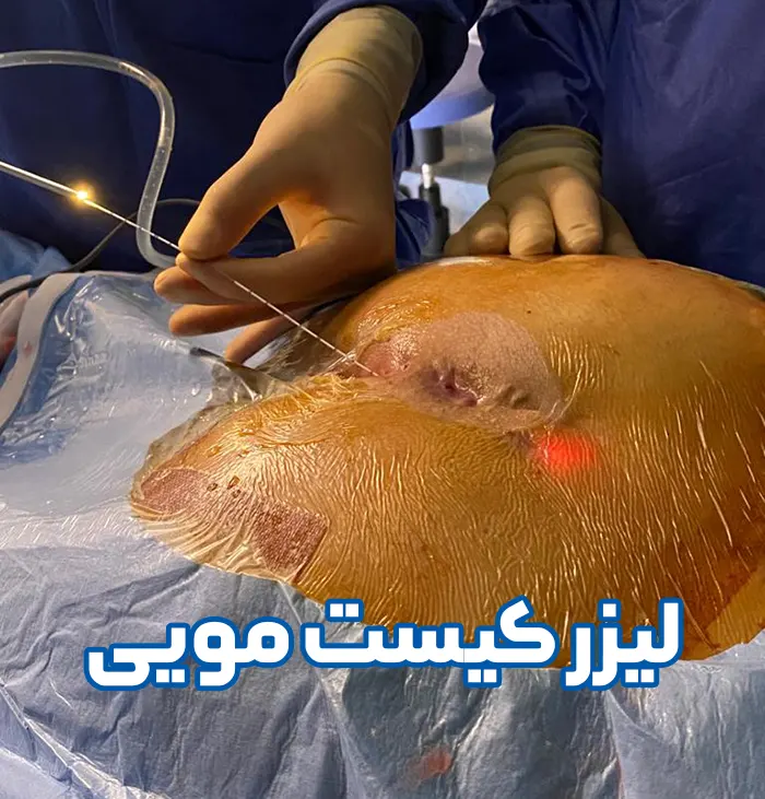 لیزر کیست مویی