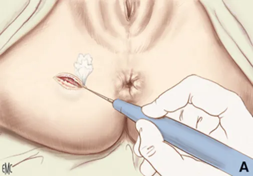 درمان آبسه با لیزر