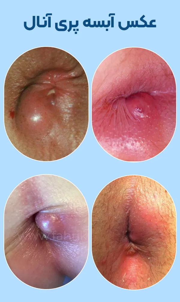 آبسه پری آنال