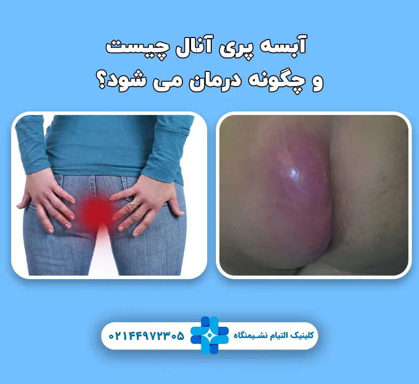 آبسه پری آنال