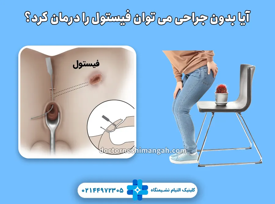 آیا بدون جراحی می توان فیستول را درمان کرد؟