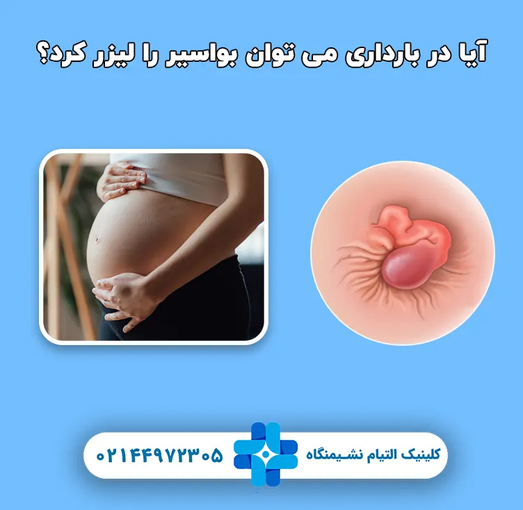 آیا در بارداری می توان بواسیر را لیزر کرد