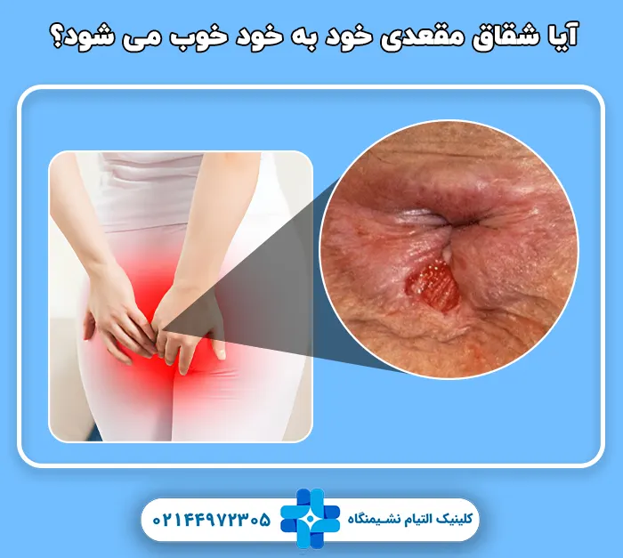 آیا شقاق مقعدی خود به خود خوب می شود؟