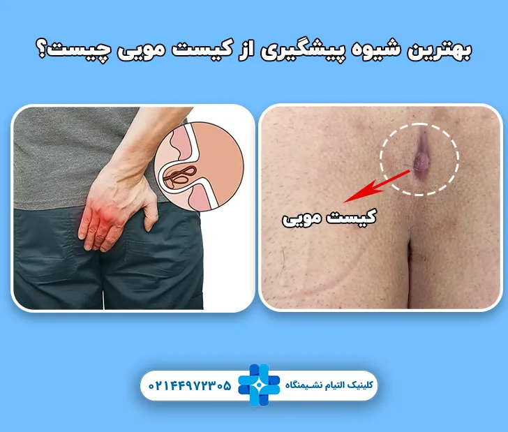 بهترین شیوه پیشگیری از کیست مویی